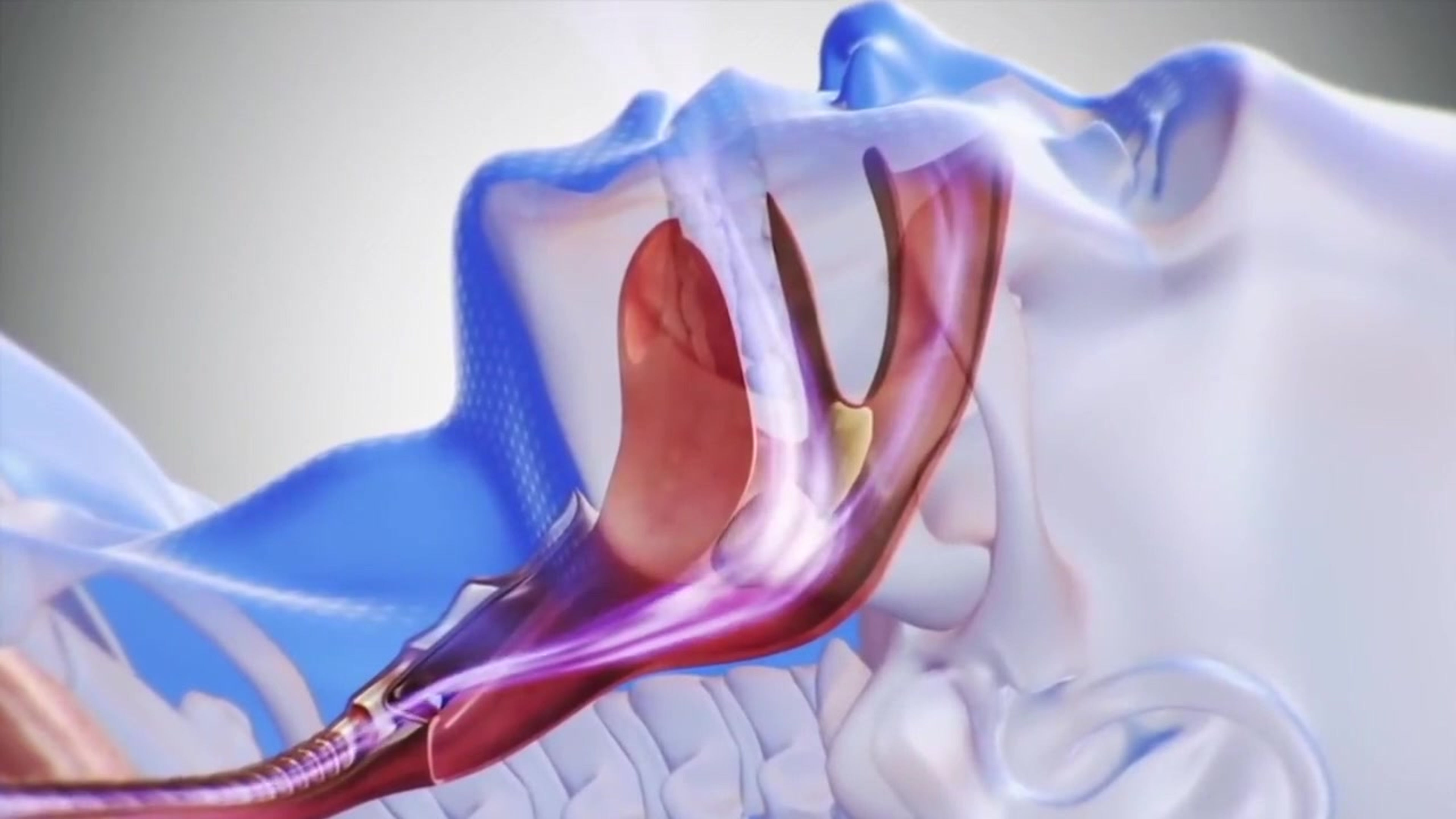 Dispositivo de Avance Mandibular